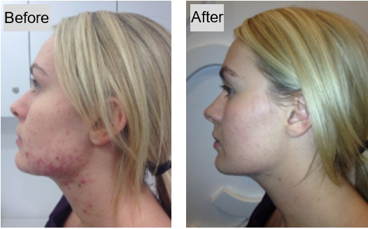Before and after photos of a young women with acne treatment.